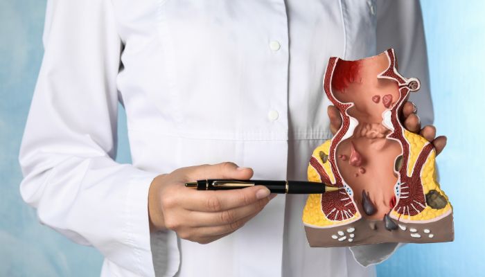 Dr Juan Antonio Villanueva - Hemorroides